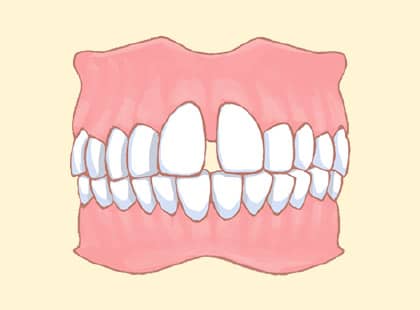 歯と歯の隙間が気になる・すきっ歯